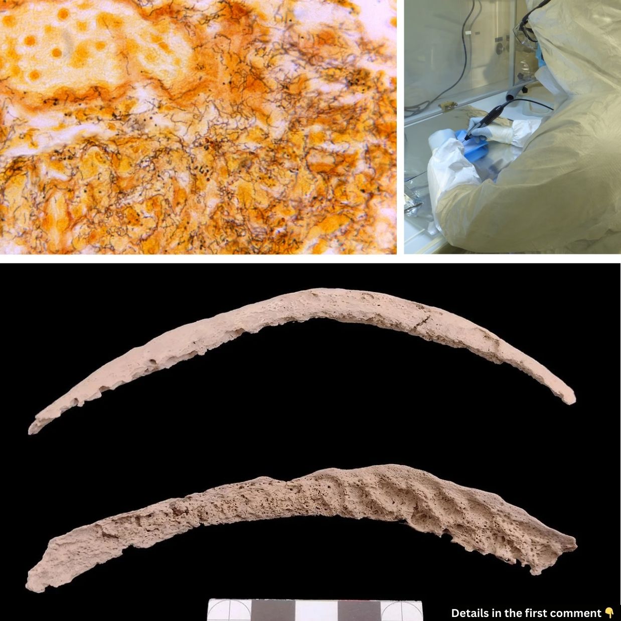 Unveiling the Origins of Syphilis: Ancient DNA Points to the Americas and Colonialism’s Role