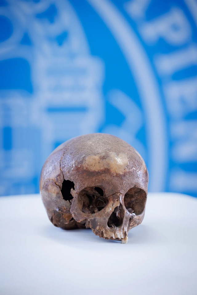 Researchers have identified the skull as belonging to a young boy in his early teens who lived with a significant developmental condition.